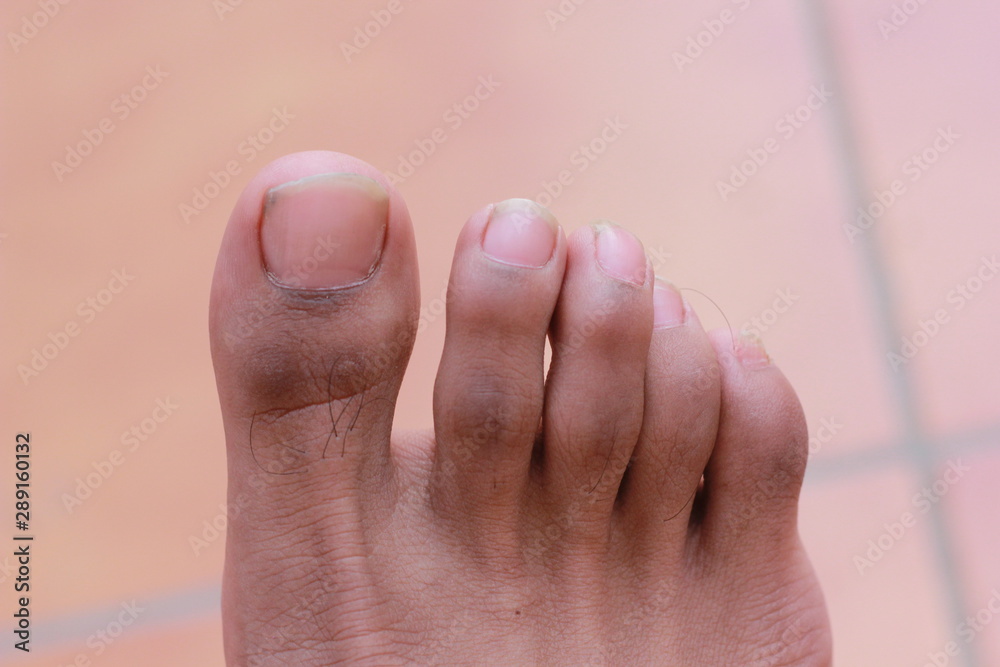 man toes with hair and dirty toenails man toes with hair and dirty toenails