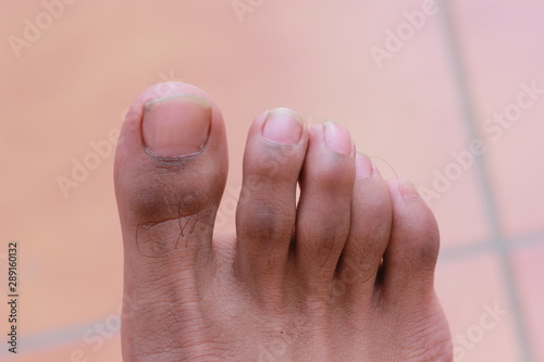 man toes with hair and dirty toenails