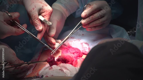 ISTANBUL, TURKEY - January 11, 2019:  Military Hospital Intestinal Surgery.