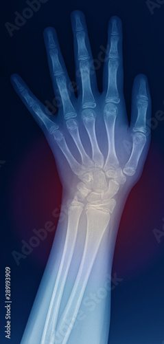 X-ray images of wrist pain © ekkarat