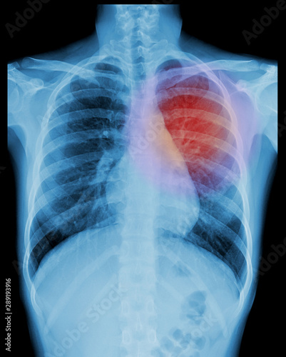 X-ray image of chest, heart, chest pain