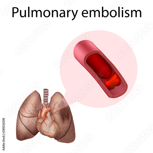 Pulmonary embolism. Lungs. Vector medical anatomy illustration.