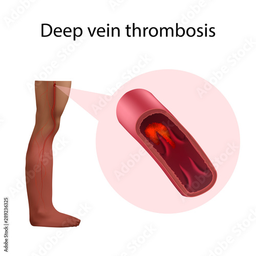 Deep vein thrombosis. Vector medical anatomy illustration.