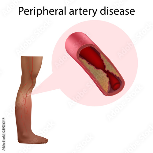 Peripheral artery disease. Vector medical anatomy illustration.