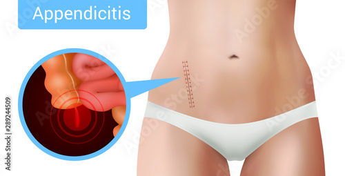 Appendicitus Surgery Infographic Background