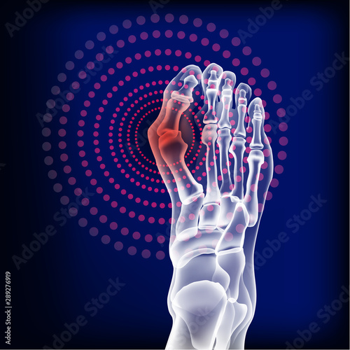 Bones the of foot with Rheumatoid arthritis