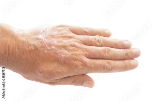 Psoriasis vulgaris and fungus on the man hand with plaque, rash and patches on the skin, isolated on white background. Autoimmune genetic disease. photo
