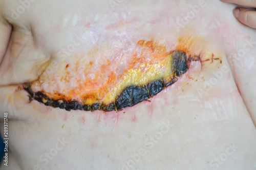 Surgical suture, breast cancer. Burn after radiation therapy. Amputation of the female breast.