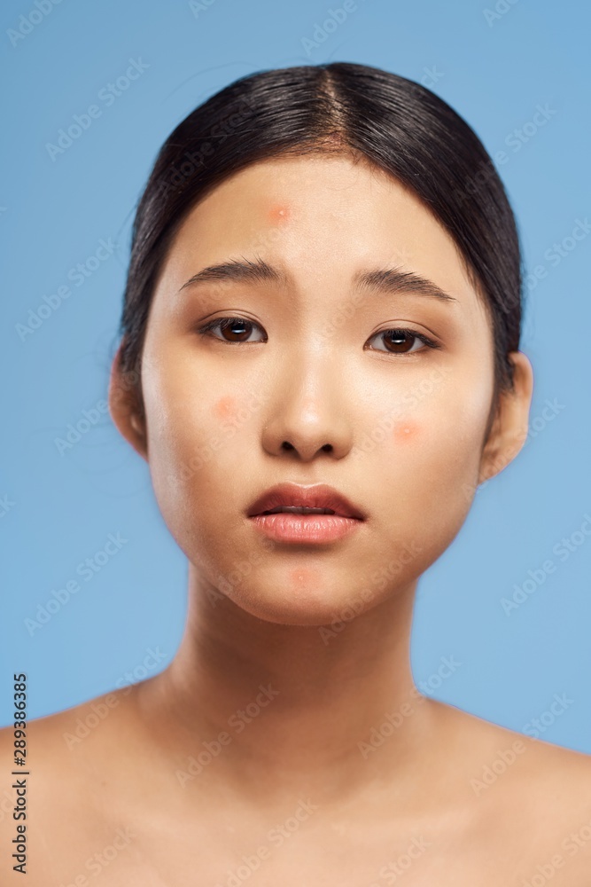 Beautiful woman with skin health problems Beautiful woman with skin health problems