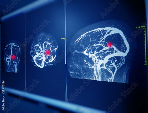 MRA AND MRV OF BRAIN  Finding:Bilateral territorial muscles to the cortex and subcortical of the parietal and low hemispheres cerebellar.