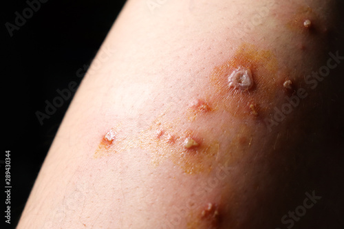 Canvastavla Blisters  Purulent wounds  Inflammation  Allergic on the skin leg of women Cause