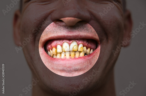 Bad man teeth. Low-quality cavity fillings.