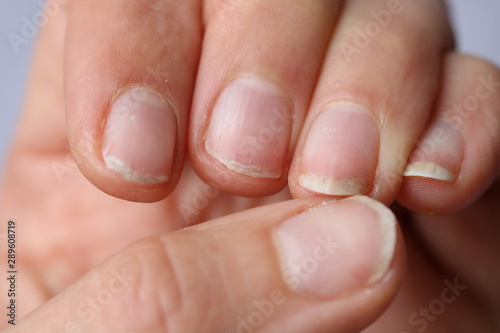 Damaged nails after gel polish. Close up. photo