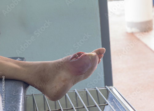 diabetes foot ulcers