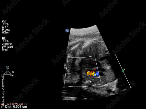 Photo Ultrasound examination of the fetal heart.