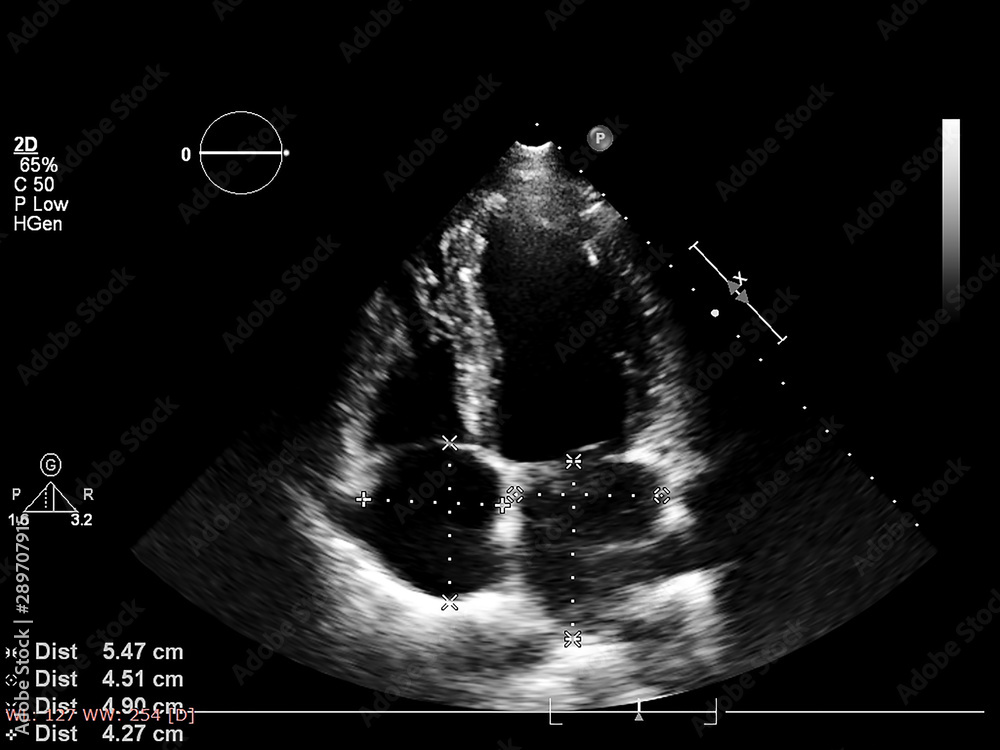 Screen of echocardiography (ultrasound) machine. Stock Photo | Adobe Stock