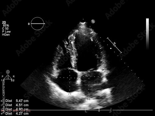 Screen of echocardiography (ultrasound) machine. photo