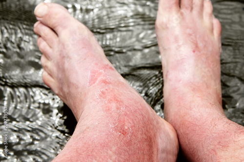 Sunburn on the skin of the foot and ankle.