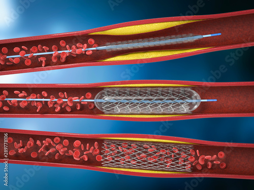 Balloon angioplasty procedure