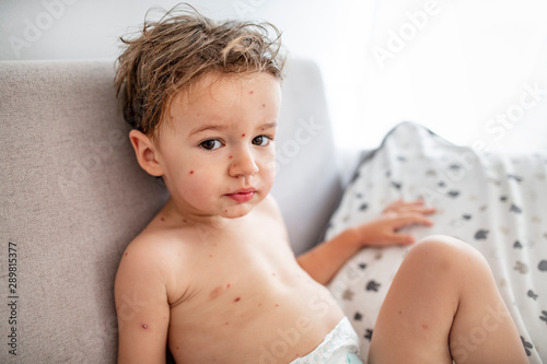 Картината върху платно Young toddler with chickenpox