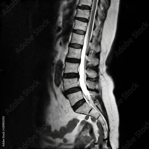 Konstfotografi MRI L-s spine or MRI of lambosacral spine or L-S spine on sagittal plane T2 technique for diagnosis spinal cord compression