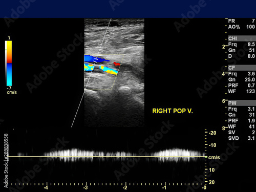 Ultrasound doppler of popliteal vien for finding  deep vein thrombosis or DVT. photo