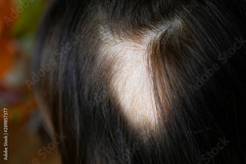 Woman hair loss. Head of woman on part of skin of which there is no hair. Maybe this is alopecia areata, lichen, trichopetia, microsporia.