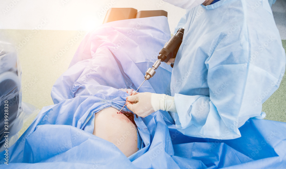 Arthroscope surgery. Orthopedic surgeons in teamwork in the operating room with modern arthroscopic tools.