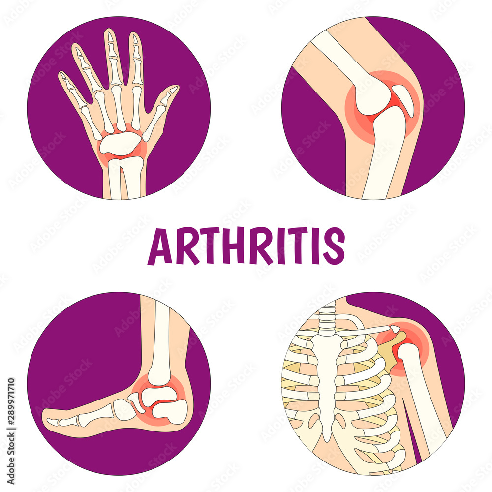 Vecteur Stock Vector Illustration on the theme World Arthritis Day