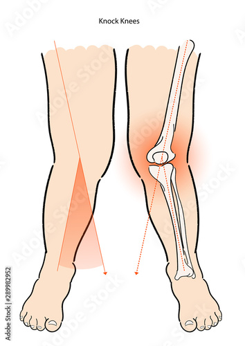 Illustration anatomy of knock knees with isolate vector