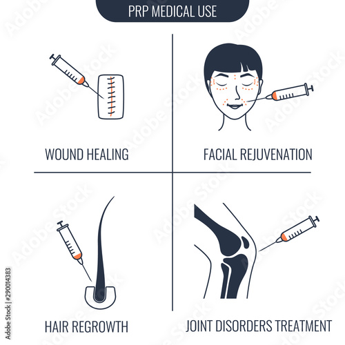 PRP medical use infographics vector set. Application of  platelet-rich plasma for wound healing, hair regrowth, facial rejuvenation, joint disorder treatment. Stem cell regenerative medicine concept. 