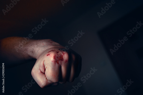 Clenched Left Hand Fist with Bloody and Bruised Knuckles Prepared to Punch Again. Domestic Violence, Abuse or Family Violence Concept.