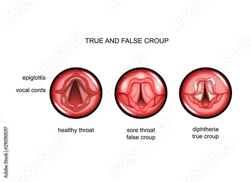 diphtheria. true and false croup