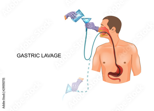 gastric lavage with a gastric tube photo