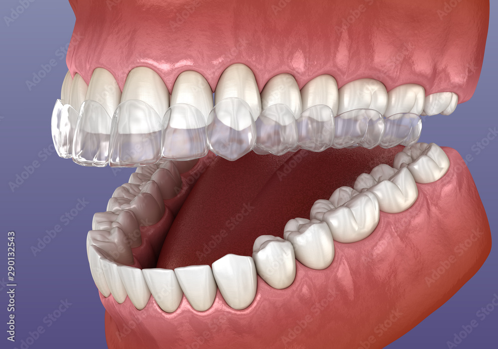 Invisalign braces or invisible retainer. Medically accurate dental 3D illustration Invisalign braces or invisible retainer. Medically accurate dental 3D illustration