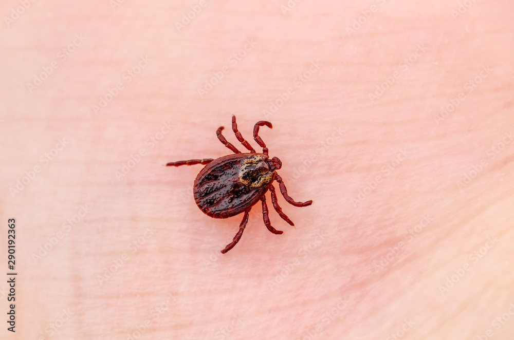 Encephalitis Virus or Lyme Borreliosis Disease Infectious Dermacentor Tick Arachnid Parasite Insect on Skin Macro Encephalitis Virus or Lyme Borreliosis Disease Infectious Dermacentor Tick Arachnid Parasite Insect on Skin Macro