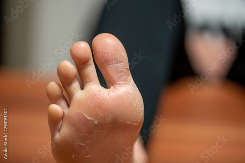 on one foot the skin detaches due to eczema photo