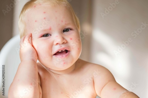 The child is sick with varicella. Measles. The child sits in a feeding chair and eats a banana.  