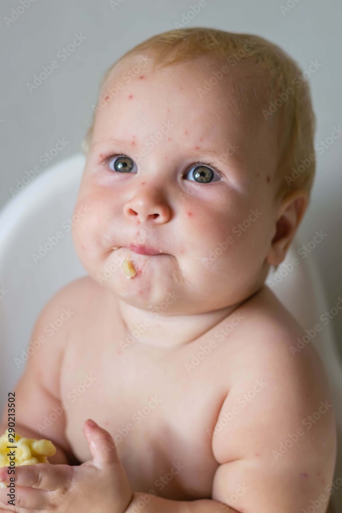 The child is sick with varicella. Measles. The child sits in a feeding chair and eats a banana. Food allergy. No vaccination. The child is sick with varicella. Measles. The child sits in a feeding chair and eats a banana. Food allergy. No vaccination.