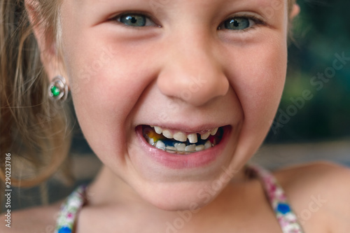 Little girl with orthodontics appliance and wobbly tooth