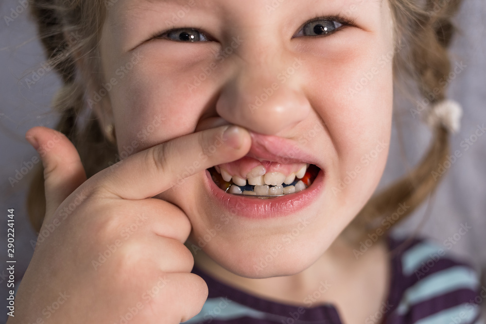 Adult permanent teeth coming in front of the child's baby teeth: shark teeth. Adult permanent teeth coming in front of the child's baby teeth: shark teeth.