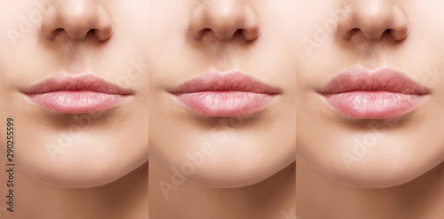 Lips of young woman before and after augmentation. photo