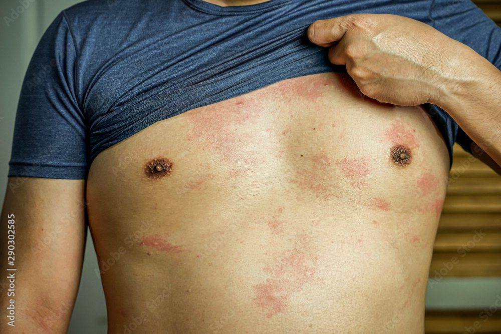 Ringworm on the body, skin infection that's caused by mold. Stock Photo |  Adobe Stock