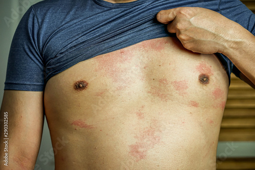 Ringworm on the body,  skin infection that’s caused by mold.
