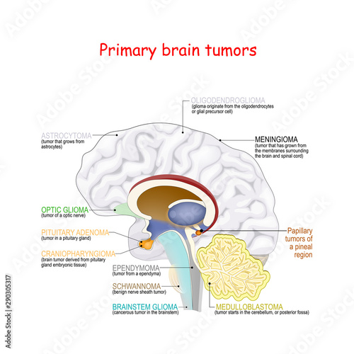 Brain cancer. different types of primary brain tumors