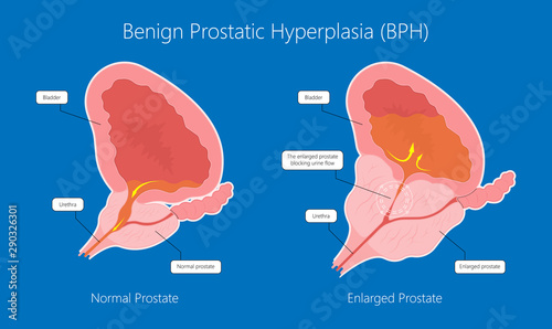Transurethral resection of the prostate stricture urine bladder digital rectal exam specific antigen Gleason score biopsies Prostatitis test blood ultrasonography Radical Prostatectomy