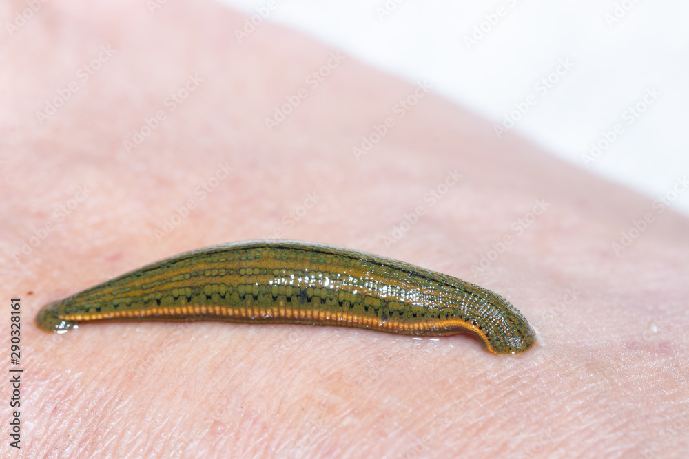 Aquatic Leech sucking blood on skin,Leeches were used in medicine from ancient Aquatic Leech sucking blood on skin,Leeches were used in medicine from ancient