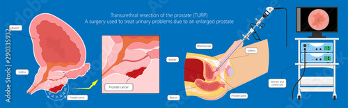 Transurethral resection of the prostate stricture urine bladder digital rectal exam specific antigen Gleason score biopsies Prostatitis test blood ultrasonography Radical Prostatectomy photo