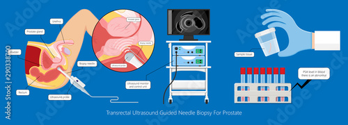 Transurethral resection of the prostate stricture urine bladder digital rectal exam specific antigen Gleason score biopsies Prostatitis test blood ultrasonography Radical Prostatectomy