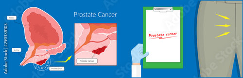 Transurethral resection of the prostate stricture urine bladder digital rectal exam specific antigen Gleason score biopsies Prostatitis test blood ultrasonography Radical Prostatectomy
